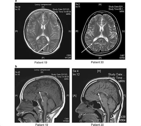 Brain Magnetic Resonance Imaging Mri Of 2 Patients With Variants