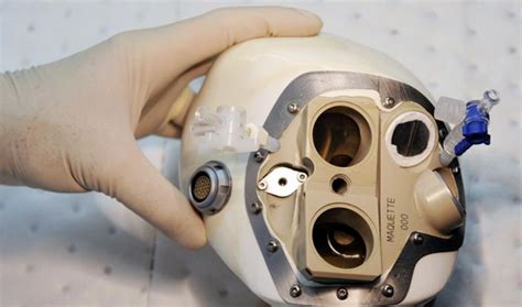 Implantan Con éxito El Primer Corazón Artificial Autónomo El Liberal