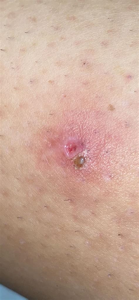 Folliculitis Popped Pus Filled Bump Let It Heal Picked The “scab
