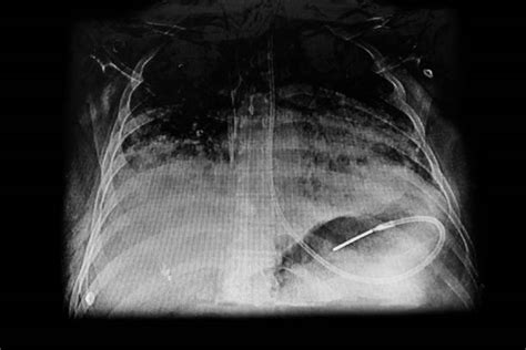 Chest X Ray Showing Nasogastric Tube Dobhoff For Feeding Image