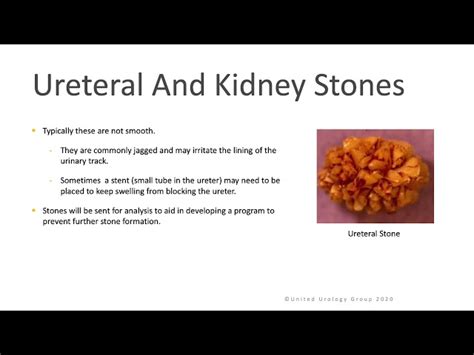 Ureteroscopy For Ureteral And Kidney Stones United Urology