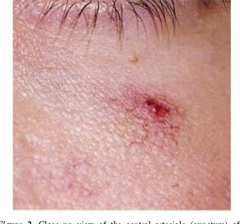 Liver Disease Skin Rashes