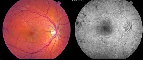 Figure 3 Fundus Photograph And Angiogram Of Patient With Mild Non