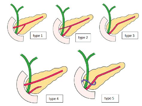 Drawings Showing Different Types Of Pancreatic Duct Configuration