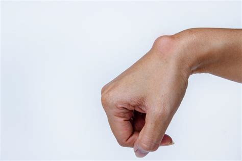 My Primary Care Physician Says I Have A Ganglion Cyst Should I Be