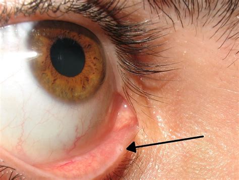 Sudden Onset One Eye Epiphora Possible Causes Scary Symptoms