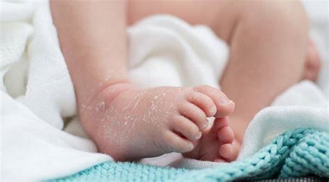 How To Manage Your Babys Dry Skin Parenting News The Indian Express