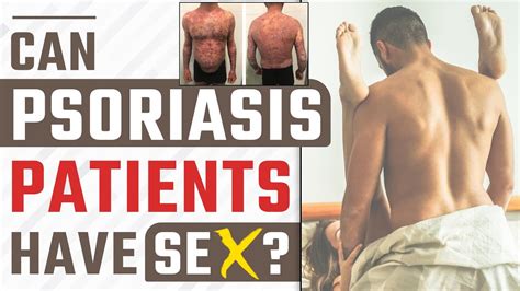 सोरायसिस मरीज को सम्भोग करना चाहिए या नहीं How Psoriasis Cause Sex