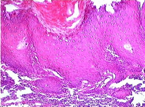 The Right Buccal Verrucous Leukoplakia With Moderate Dysplasia 2nd