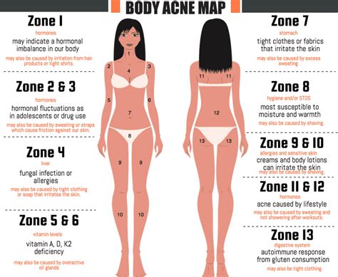 What Does Acne Reveal About Your Health Acne Face Map What Does Acne Reveal About Your Health