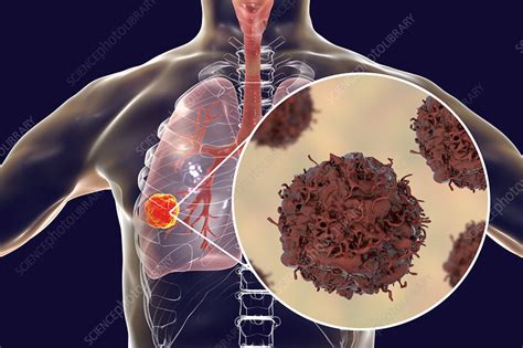Lung Cancer Illustration Stock Image F0221934 Science Photo Library