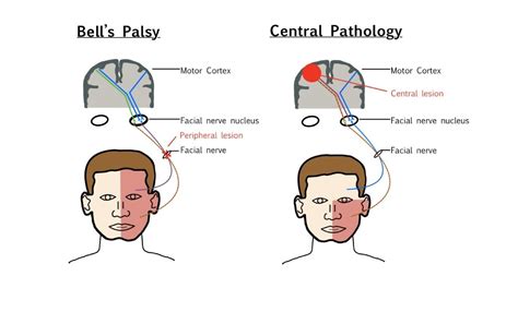 Bells Palsy Diagnosis And Treatment Emergency Care Bc