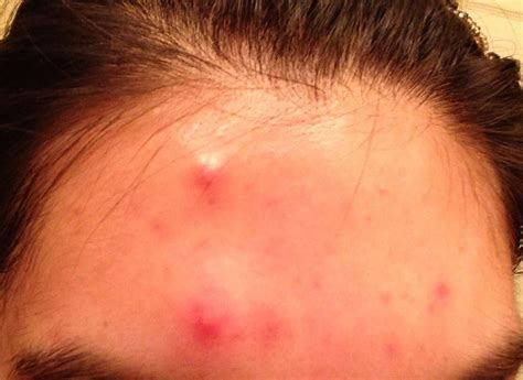 Best Organic Skin Care 2017 Foreheadacne Pimples On Forehead