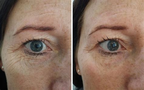 Viora Reaction Radiofrequency Skin Tightening Eyes Renew Medical