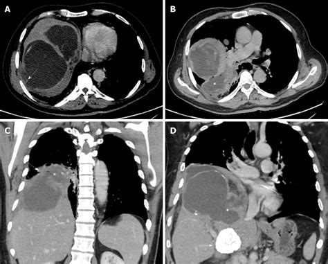 Thoracic Hydatid Disease A Radiologic Review Of Unusual Cases