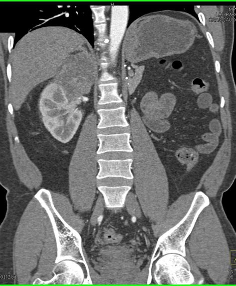 Recurrent Renal Cell Carcinoma Metastatic To The Contralateral Kidney