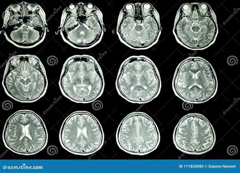 Mri Scan Of Patient Brain Stock Photo Image Of Hospital 111820080