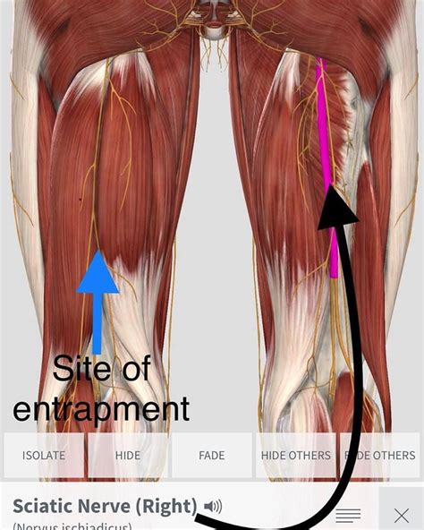 Here Is Another Common Site Of Sciaticnerve Entrapment Between The