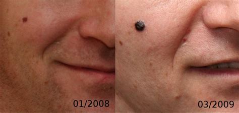 What Does Stage 1 Skin Cancer Look Like Cancerwalls