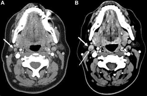 Lymph Node Dissection Radiology Key