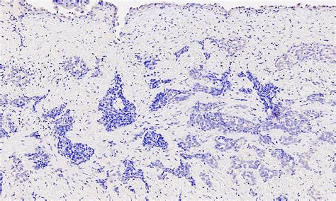 Pathology Outlines Mesothelioma Epithelioid