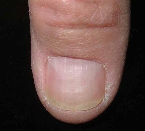 The trauma that leads to blood under a toenail isn't always blunt and painful at the time of occurrence. nail bed melanoma - pictures, photos