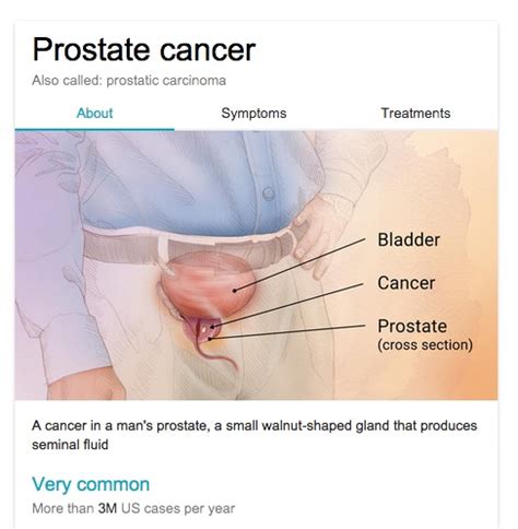 If your prostate cancer comes back. Mayo Clinic and Google Knowledge Panels - Social Media ...