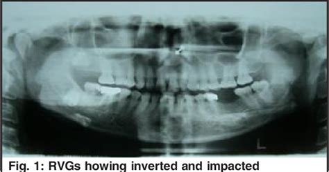 Figure 1 From Inverted And Impacted Maxillary And Mandibular 3rd Molars