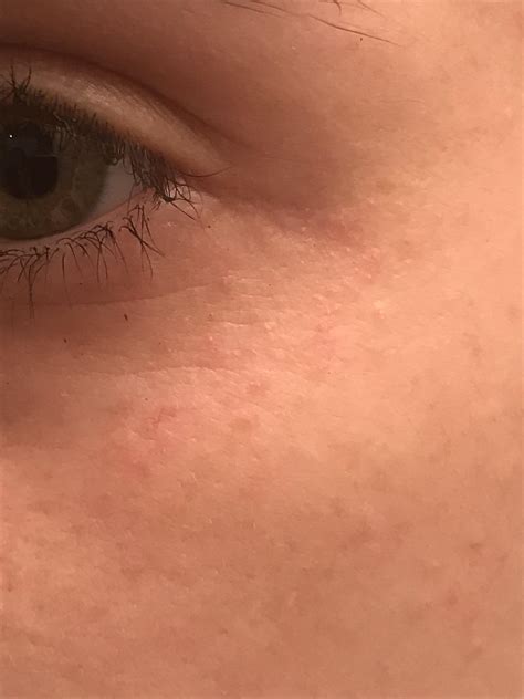 Weird Little Red Bumps By My Eyes I Dont Think This Picture Is