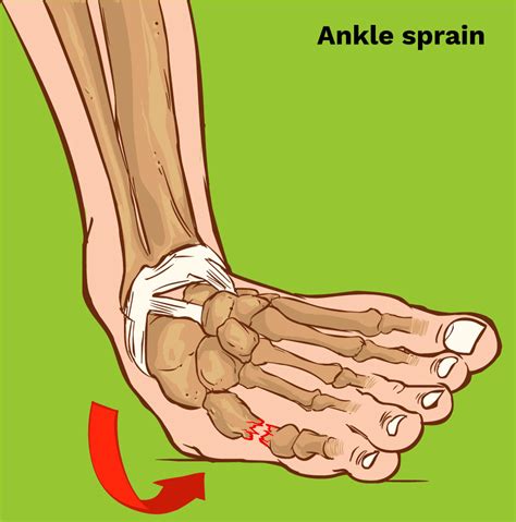 The Best Treatment For A Sprained Ankle Physiomotion Rotterdam