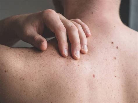 Abituarsi A Mento Nel Itchy Skin All Over Body With Tiny Bumps Veloce