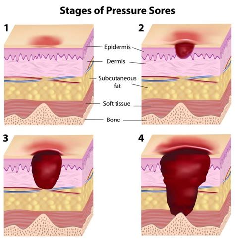 English For Nurses IELTS Vocabulary Pressure Ulcer Stages Online