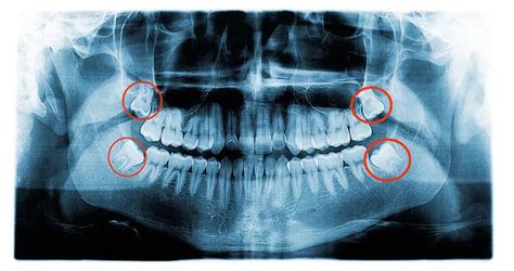 Impacted Wisdom Teeth Causes Signs And Symptoms