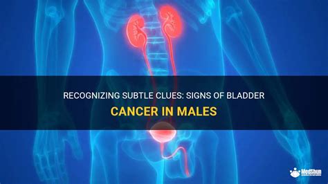 Recognizing Subtle Clues Signs Of Bladder Cancer In Males Medshun
