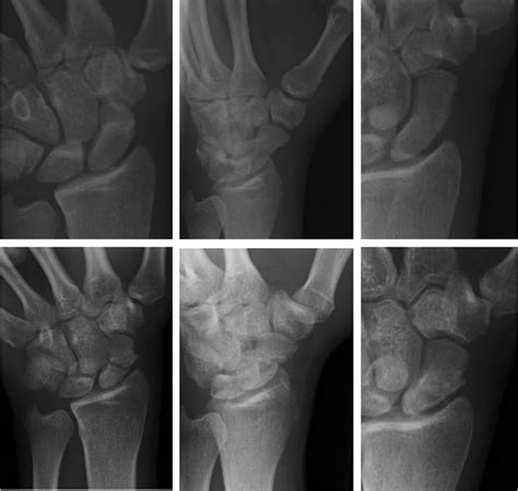 Scaphoid Fracture And Other Types Of Wrist Fractures