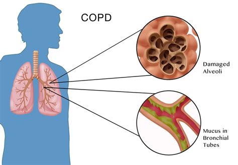 Pathophysiology Of Chronic Obstructive Pulmonary Dise