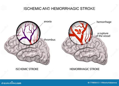 Multiple Forms Of Stroke Ischemic Strokes Hemorrhagic