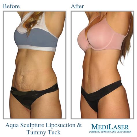 Tummy Tuck Before And After Medilaser Surgery And Vein Center