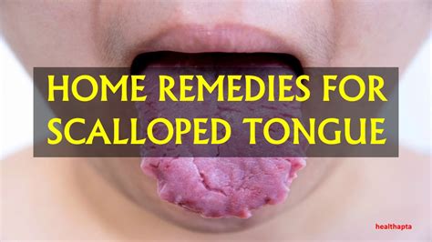 Home Remedies For Scalloped Tongue Youtube