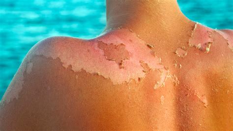 Why Sunburn Peeling Is Both A Good And Bad Thing For Your Skin Allure