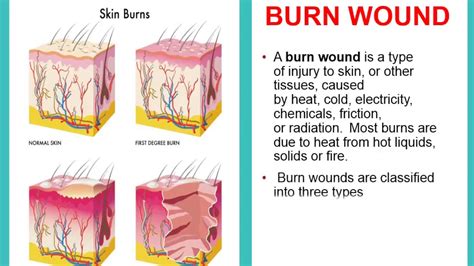 Classifications Of Burns