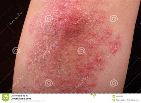 Psoriasis Stock Image Image Of Patch Dermatology Redness 84006141