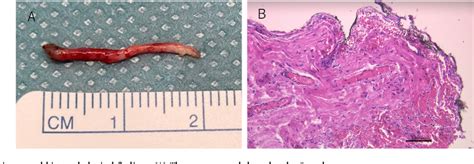 Figure 3 From Ureteral Fibroepithelial Polyp A Case Report Semantic