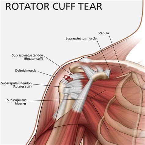 Rotator Cuff Injury Physical Therapy And Surgery