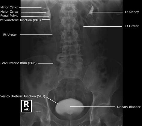 Abdominal Radiographic Anatomy Wikiradiography Radiology Student
