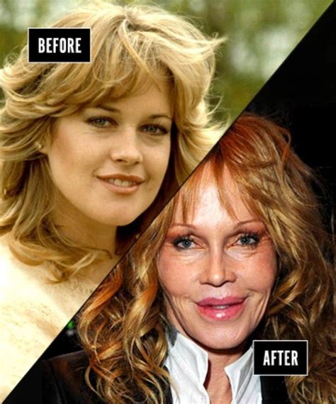 Melanie Griffith 1980 / 2015 | Plastic surgery gone wrong ...