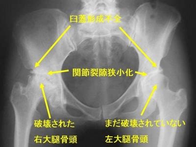 変形性股関節症・変形性膝関節症の症状・診断・治療 [骨・筋肉 ...