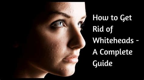 How To Get Rid Of Whiteheads A Complete Guide