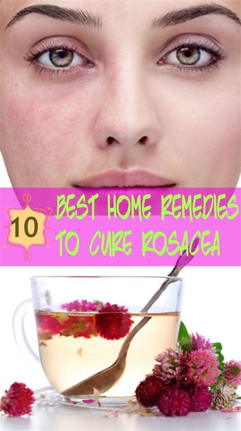 10 Best Home Remedies To Cure Of Rosacea