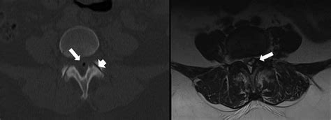A Rare Cause Of Low Back Pain Intraspinal Synovial Cyst